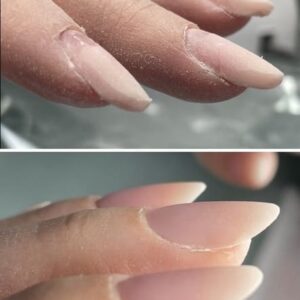 nail correction